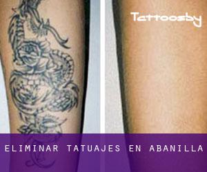 Eliminar tatuajes en Abanilla
