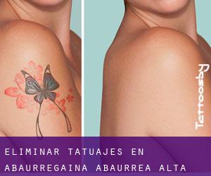 Eliminar tatuajes en Abaurregaina / Abaurrea Alta