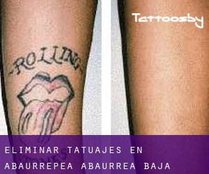 Eliminar tatuajes en Abaurrepea / Abaurrea Baja