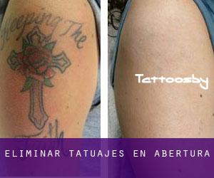 Eliminar tatuajes en Abertura