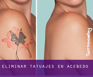 Eliminar tatuajes en Acebedo