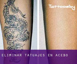 Eliminar tatuajes en Acebo