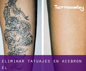 Eliminar tatuajes en Acebrón (El)
