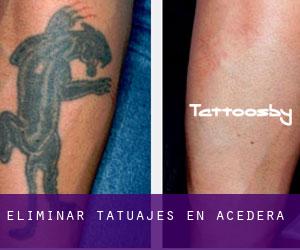 Eliminar tatuajes en Acedera