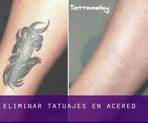 Eliminar tatuajes en Acered