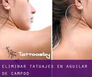 Eliminar tatuajes en Aguilar de Campóo