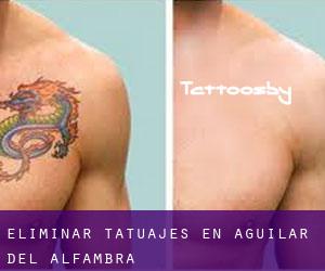 Eliminar tatuajes en Aguilar del Alfambra