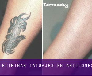 Eliminar tatuajes en Ahillones