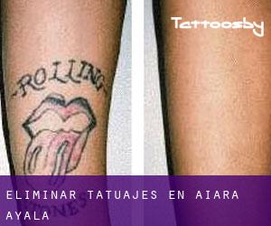Eliminar tatuajes en Aiara / Ayala