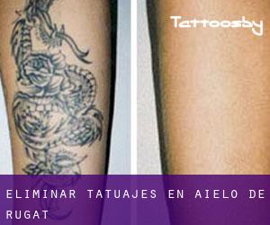 Eliminar tatuajes en Aielo de Rugat