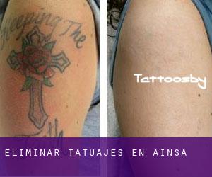 Eliminar tatuajes en Aínsa