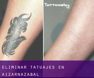 Eliminar tatuajes en Aizarnazabal