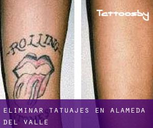 Eliminar tatuajes en Alameda del Valle