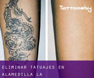 Eliminar tatuajes en Alamedilla (La)