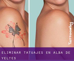 Eliminar tatuajes en Alba de Yeltes