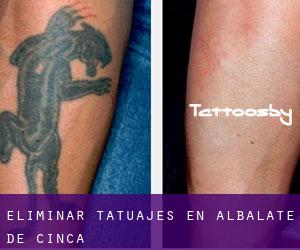 Eliminar tatuajes en Albalate de Cinca