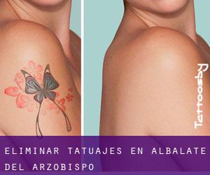 Eliminar tatuajes en Albalate del Arzobispo