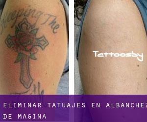 Eliminar tatuajes en Albanchez de Mágina