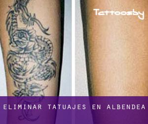 Eliminar tatuajes en Albendea