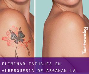 Eliminar tatuajes en Alberguería de Argañán (La)