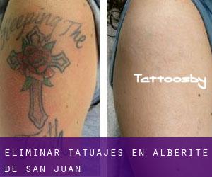 Eliminar tatuajes en Alberite de San Juan