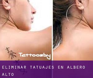 Eliminar tatuajes en Albero Alto