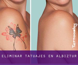 Eliminar tatuajes en Albiztur