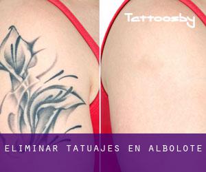 Eliminar tatuajes en Albolote