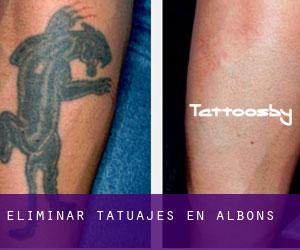 Eliminar tatuajes en Albons