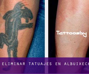 Eliminar tatuajes en Albuixech