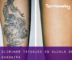 Eliminar tatuajes en Alcalá de Guadaira