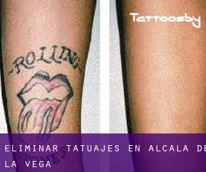 Eliminar tatuajes en Alcalá de la Vega