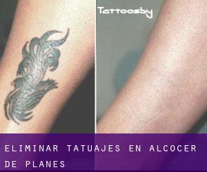 Eliminar tatuajes en Alcocer de Planes