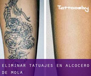 Eliminar tatuajes en Alcocero de Mola