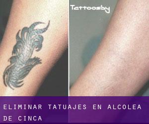 Eliminar tatuajes en Alcolea de Cinca