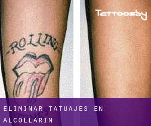 Eliminar tatuajes en Alcollarín