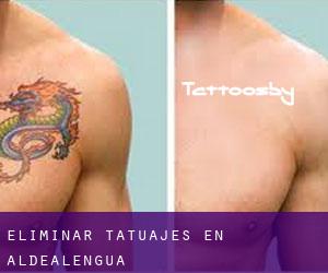 Eliminar tatuajes en Aldealengua