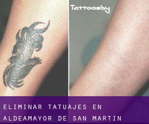 Eliminar tatuajes en Aldeamayor de San Martín