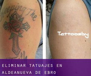 Eliminar tatuajes en Aldeanueva de Ebro