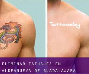 Eliminar tatuajes en Aldeanueva de Guadalajara