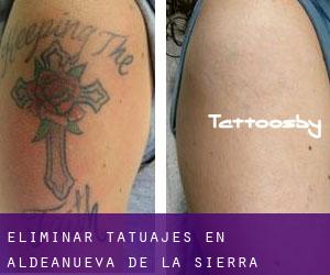 Eliminar tatuajes en Aldeanueva de la Sierra