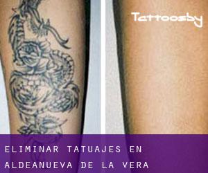 Eliminar tatuajes en Aldeanueva de la Vera