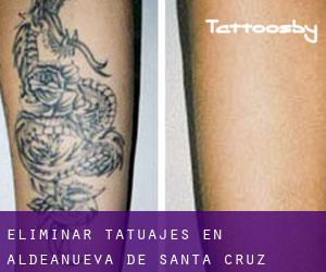 Eliminar tatuajes en Aldeanueva de Santa Cruz
