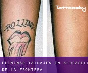 Eliminar tatuajes en Aldeaseca de la Frontera