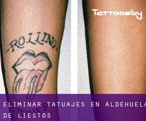 Eliminar tatuajes en Aldehuela de Liestos