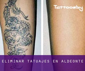 Eliminar tatuajes en Aldeonte