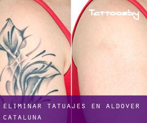 Eliminar tatuajes en Aldover (Cataluña)