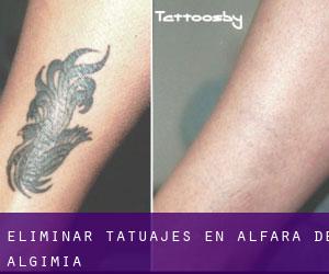 Eliminar tatuajes en Alfara de Algimia