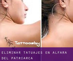Eliminar tatuajes en Alfara del Patriarca