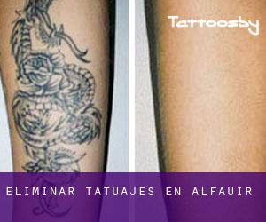 Eliminar tatuajes en Alfauir